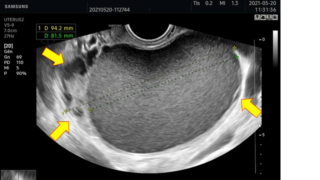 Ovarian Endometriosis